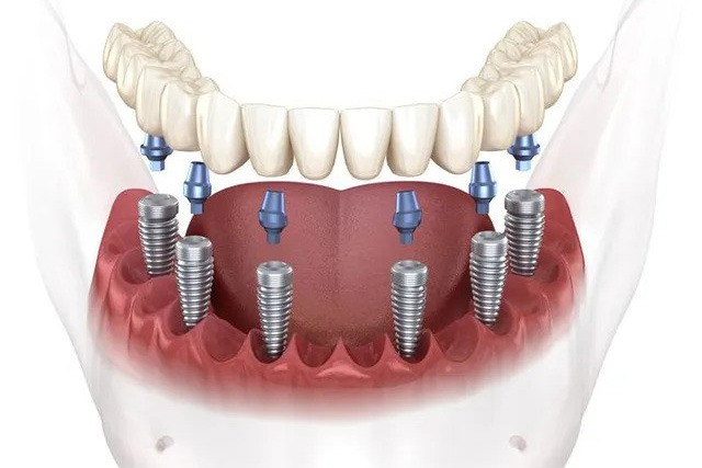 mediDental care | Dental Fillings, Emergency Treatment and Full Arch Dental Implant