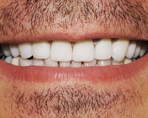 mediDental care | Veneers, All-on-6 and TMJ Disorders