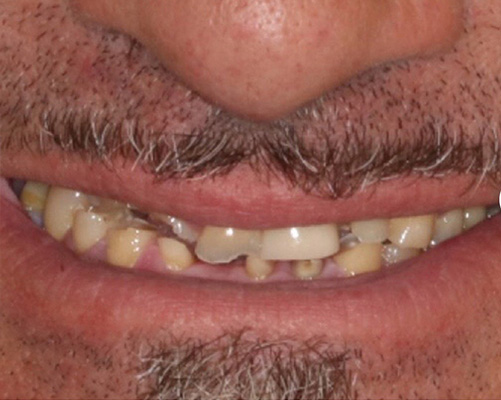 mediDental care | Dental Bridges, Invisalign&reg; and Ceramic Crowns